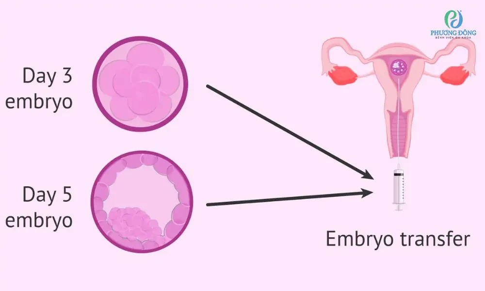 Sau chuyển phôi bao lâu thì phôi làm tổ? Nhận biết thụ thai thành công